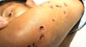 Dramma nell'avellinese, 35enne attaccato dai calabroni: è in fin di vita