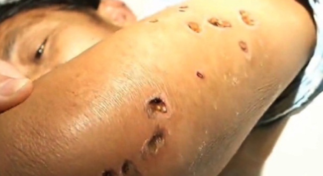 Dramma nell'avellinese, 35enne attaccato dai calabroni: è in fin di vita