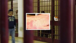 Altro che Covid, la scabbia 'invade' Poggioreale: detenuti infetti e isolati