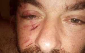 Baby gang aggrediscono ex Consigliere comunale: la foto pubblicata su Facebook