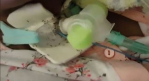 Ricoperta di formiche al San Giovanni Bosco, è morta l'anziana paziente