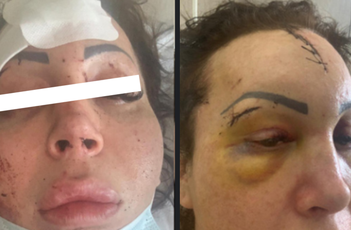 Napoli, Federica massacrata di botte perché trans