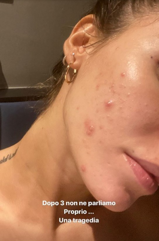 Giulia De Lellis comunica ai follower il suo problema con l'acne: "Non dobbiamo fermarci"