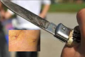 Mergellina, accoltellato al braccio e al torace: "È stato l'ex di una mia amica"