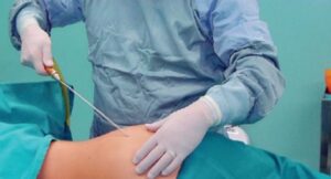 Capaccio, morto Michele Alfano: in coma dopo una liposuzione