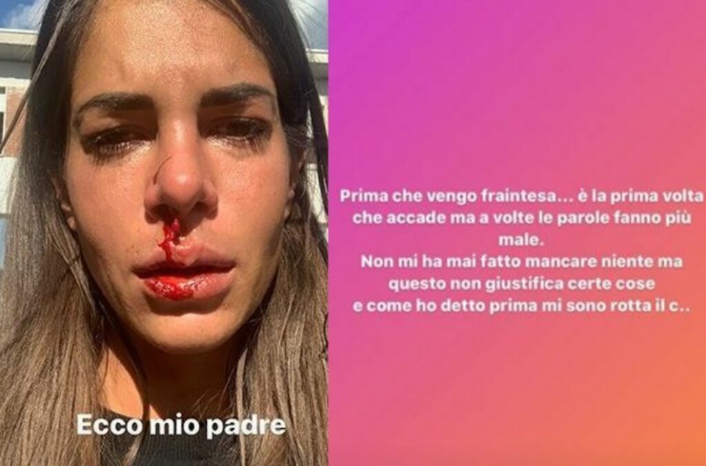 Giada Giovannelli picchiata dal padre, la foto del naso sanguinante: "Sono al pronto soccorso"