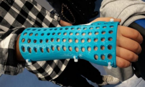 santobono napoli esoscheletro 3D