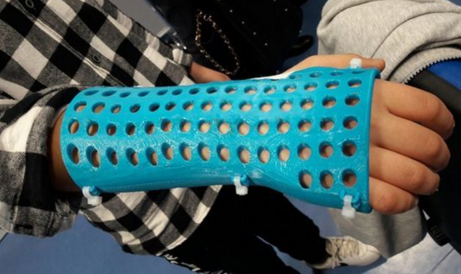 santobono napoli esoscheletro 3D