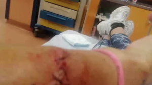 Aggredita e accoltellata sul lungomare di Napoli