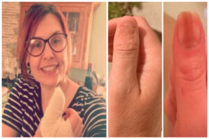 Credeva fosse una macchia sull’unghia era un tumore: Alana salva per miracolo