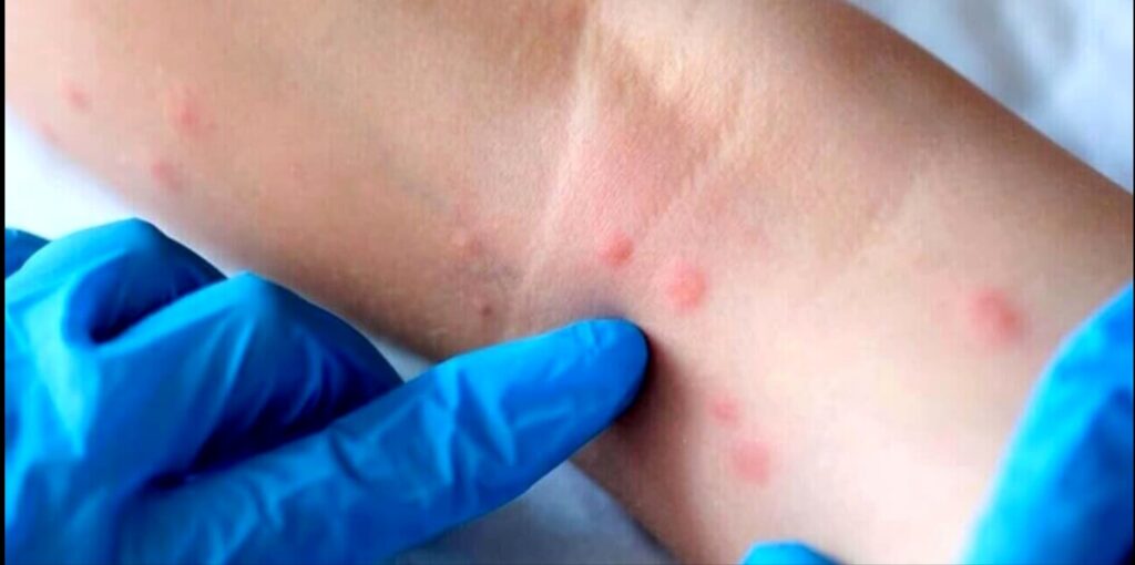 Vaiolo delle scimmie a Caivano