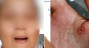 Piaghe alle mani per 20€ dopo 7 ore di lavoro in pizzeria