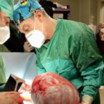 Rimosso tumore di 9 chili al Pascale