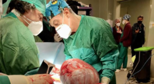 Rimosso tumore di 9 chili al Pascale