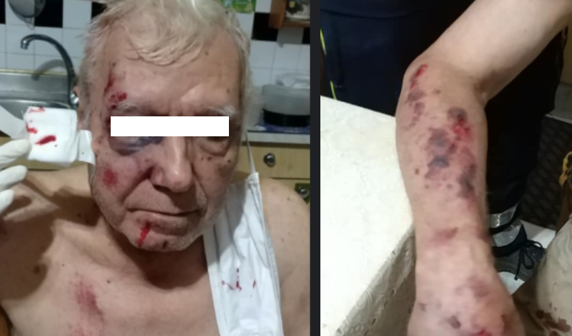 Nocera, anziano di 83 anni pestato a sangue: fratture ed ematomi su tutto il corpo