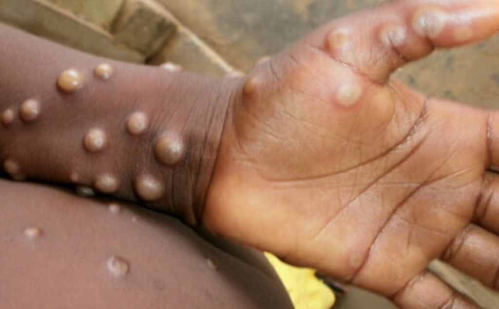 Vaiolo delle scimmie, l'allarme dell'OMS: "Il pericolo dell'epidemia a feste e festival"