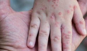 Vaiolo delle scimmie Campania