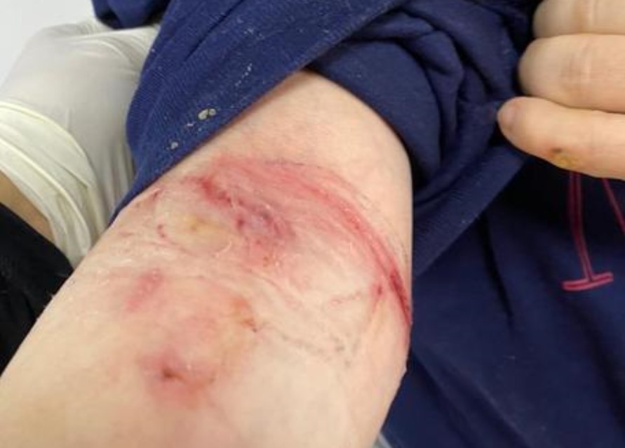 Bufera al Cardarelli, la denuncia di una mamma: "Mia figlia down legata e mandata a casa senza Tac"