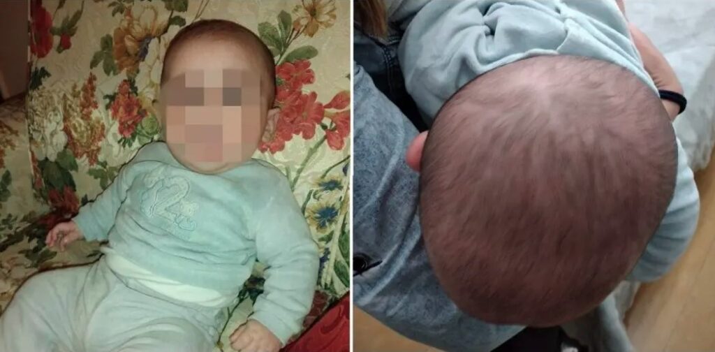 Neonato con malformazione cranica lotta con la burocrazia per ottenere cappello correttivo: la denuncia del papà