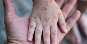 Il vaiolo delle scimmie