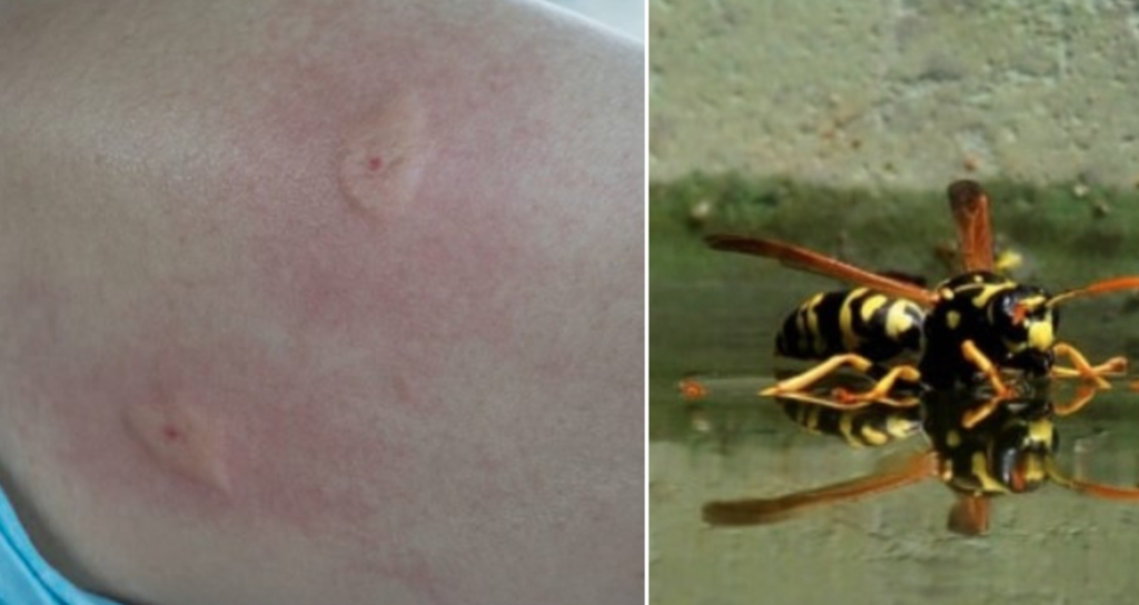 Napoli, calabrone asiatico punge uomo sul motorino: "Aiutatemi", poi la corsa in ospedale